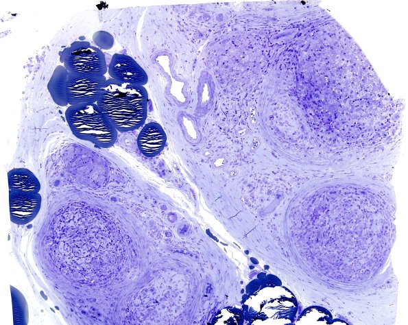 6A1 Leprosy, tuberculoid (Case 6) Plastic 7