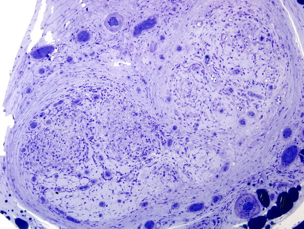 6A2 Leprosy, tuberculoid (Case 6) Plastic 8