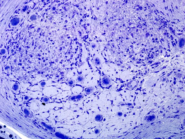 6A3 Leprosy, tuberculoid (Case 6) Plastic 9