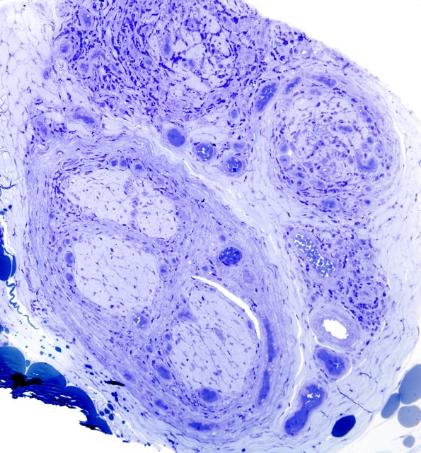 6A4 Leprosy, tuberculoid (Case 6) Plastic 13