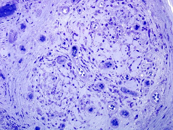 6A5 Leprosy, tuberculoid (Case 6) Plastic 10