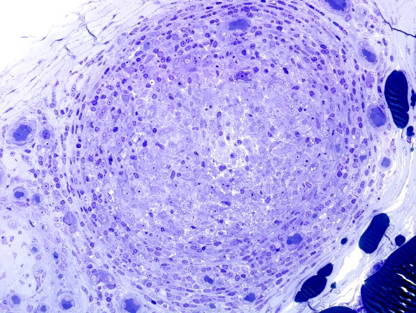 6A6 Leprosy, tuberculoid (Case 6) Plastic 12