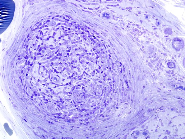 6A7 Leprosy, tuberculoid (Case 6) Plastic 19