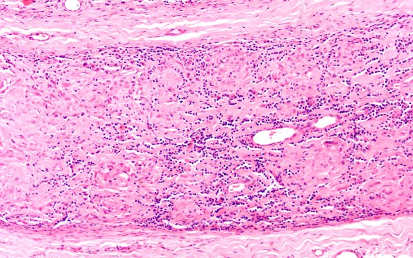 7A1 Leprosy, Tuberculoid (Case 7) H&E 20X 1