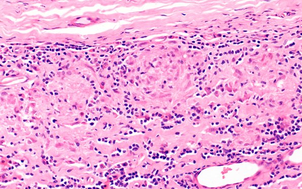 7A3 Leprosy, Tuberculoid (Case 7) H&E 40X 1