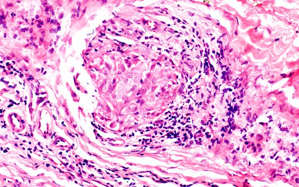 7A4 Leprosy, Tuberculoid (Case 7) H&E 40X 2