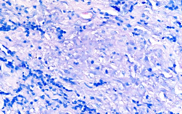7B Leprosy, Tuberculoid (Case 7) 60X AFB 1
