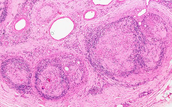 8A1 Leprosy, Tuberculoid (Case 8) 10X 1