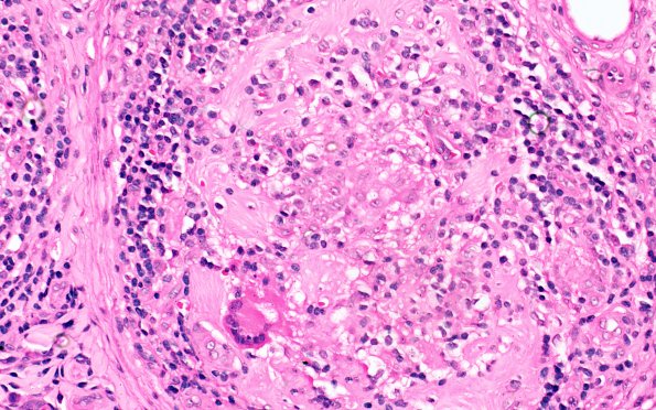 8A3 Leprosy, Tuberculoid (Case 8) 40X 2