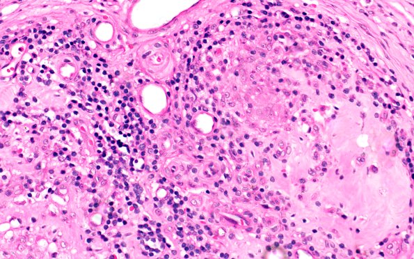 8A4 Leprosy, Tuberculoid (Case 8) 40X 1