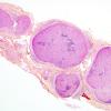 1A3A Leprosy, pure neuritic form,  borderline TB type (Case 1) , HPS Trichr - Copy