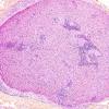 1A3B Leprosy, pure neuritic form (Case 1) , HPS Trichr - Copy (2)