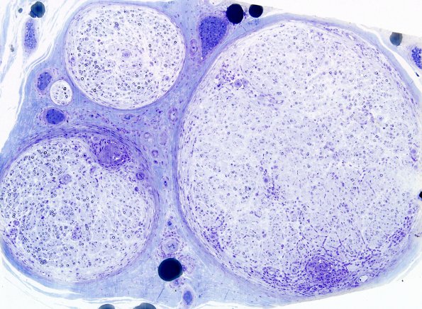 1B1A Leprosy, tuberculoid (Case 1) Plastic 8