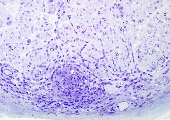 1B1B Leprosy, tuberculoid (Case 1) Plastic 1