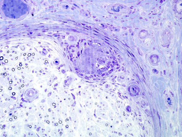 1B1C (Case 1) BPlastic 10