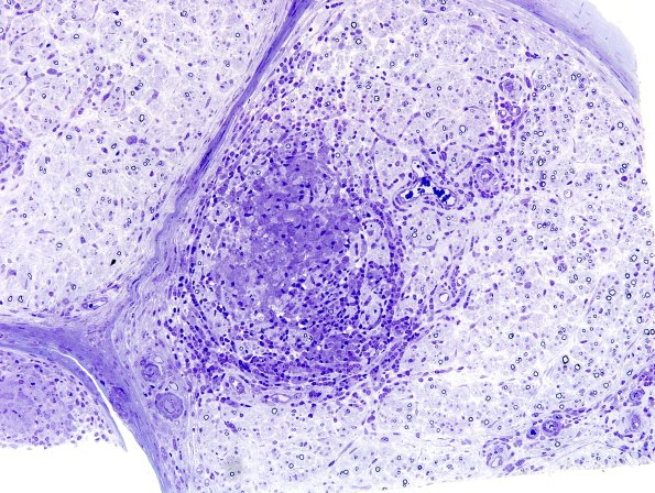1B2A Leprosy, tuberculoid (Case 1) Plastic 19A