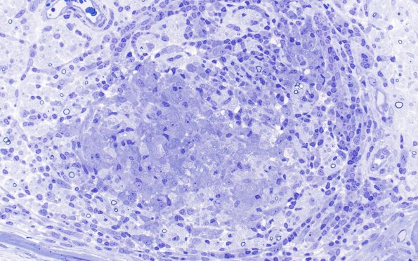 1B2A Leprosy, tuberculoid (Case 1) Plastic 40X 1