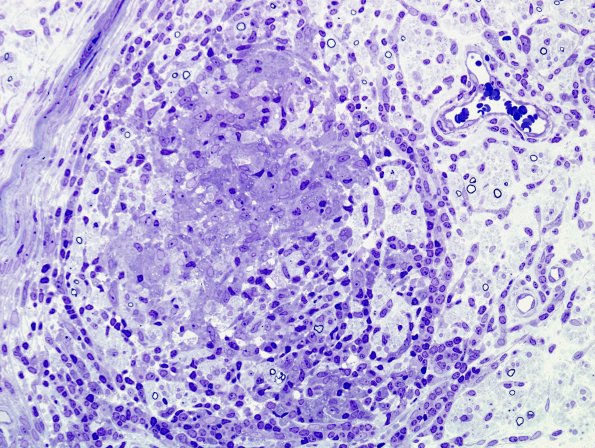 1B2B Leprosy, tuberculoid (Case 1) Plastic 11