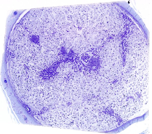 1B3A Leprosy, tuberculoid (Case 1) Plastic 4