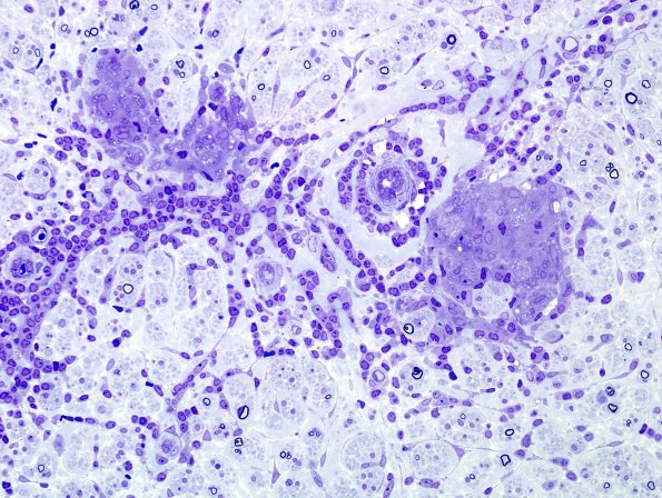 1B3B Leprosy, tuberculoid (Case 1) Plastic 7