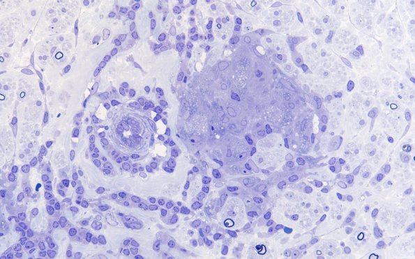 1B3C Leprosy, tuberculoid (Case 1) Plastic 60X