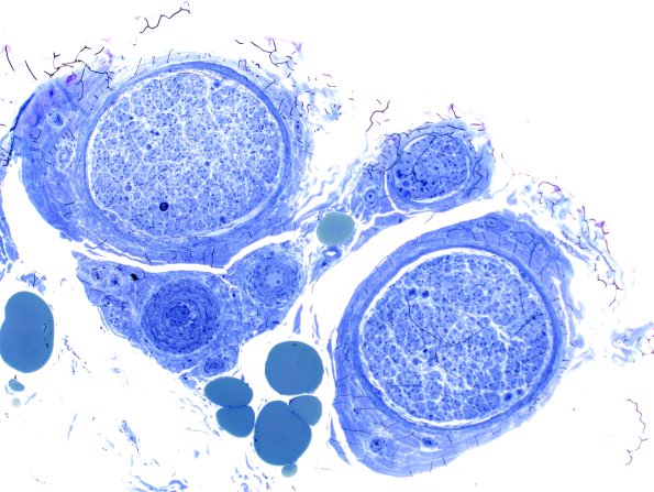 13B1 (Case 13) Plastic 10X