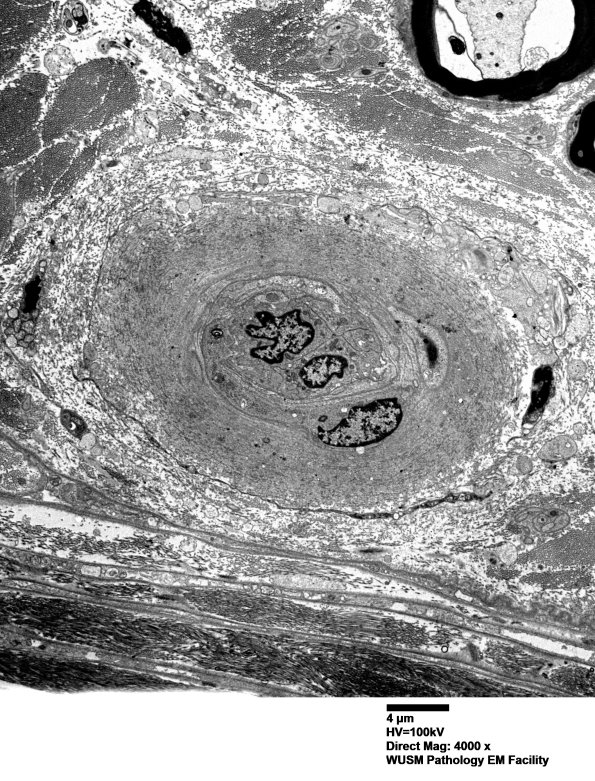 14B1A (Case 14) EM002 - Copy