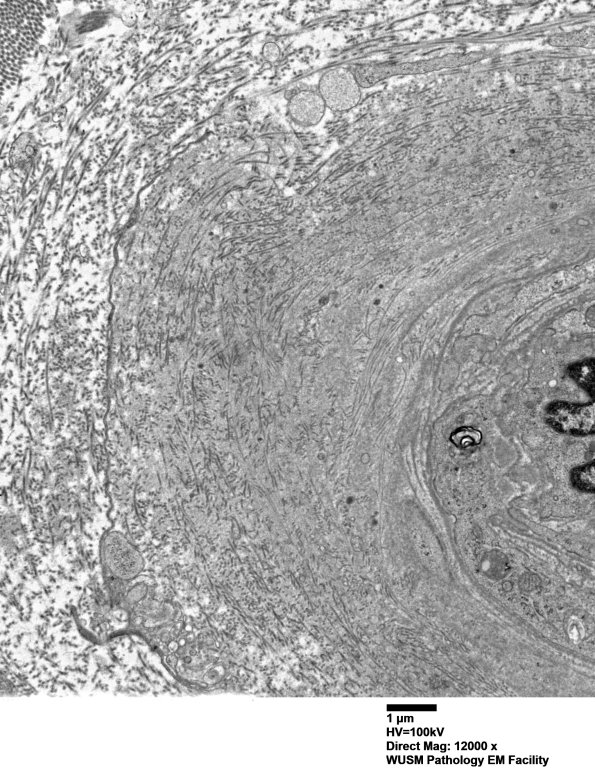 14B1B (Case 14) EM004 - Copy