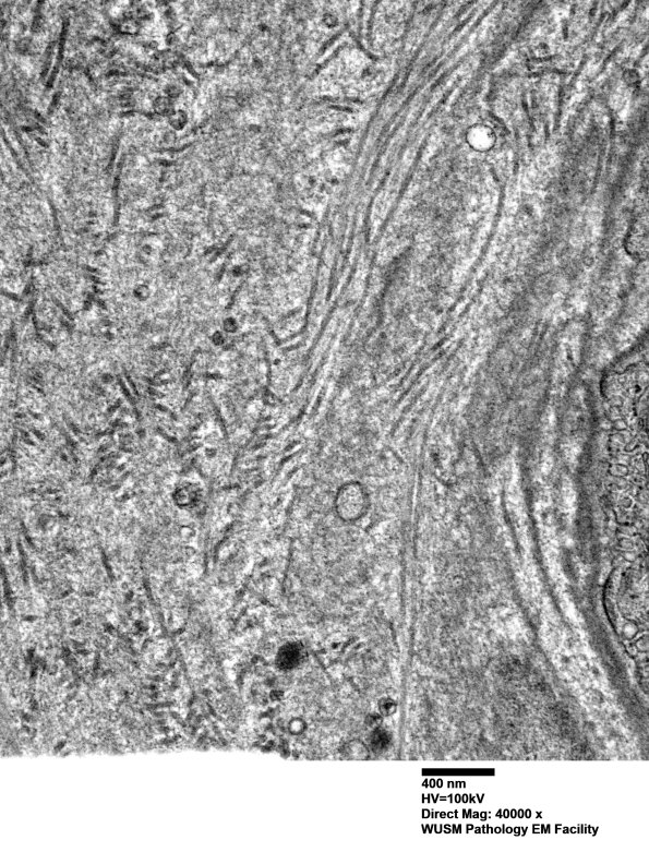 14B1C (Case 14) EM005 - Copy