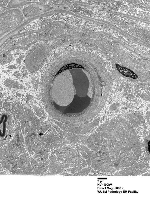 14B2A (Case 14) EM016 - Copy