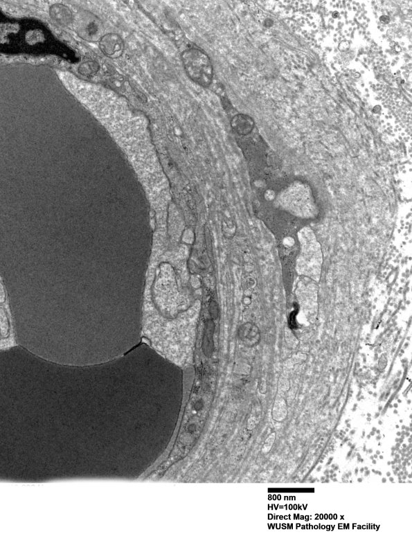 14B2B (Case 14) EM011 - Copy