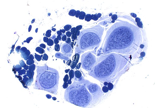 15A1 (Case 15) HIEM Plastic 4X 2