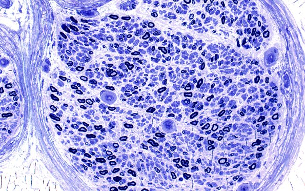 15A2 (Case 15) HIEM Plastic 20X