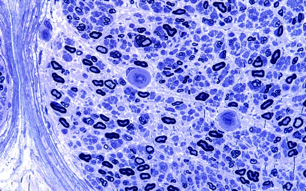 15A3 (Case 15) HIEM Plastic 60X 2