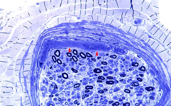 15A4 (Case 15) HIEM Plastic 60X copy