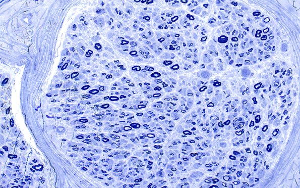 16A2 (Case 16) HIEM Plastic 40X