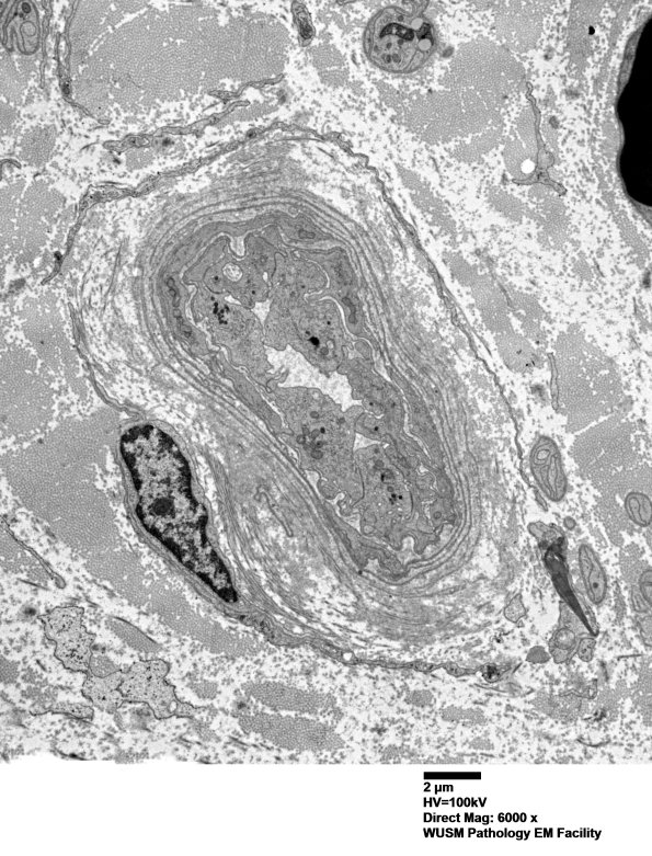 16B1 (Case 16) HIEM EM017 - Copy