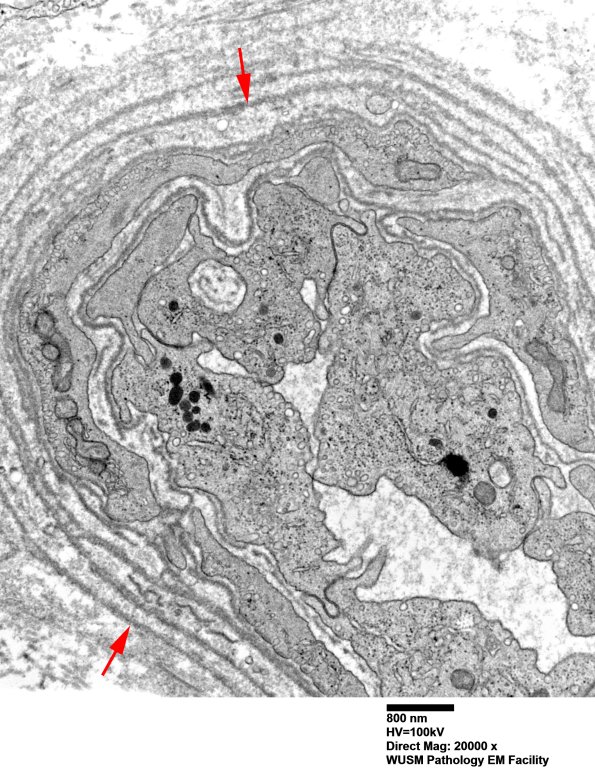 16B2 (Case 16) HIEM EM018 - Copy copy