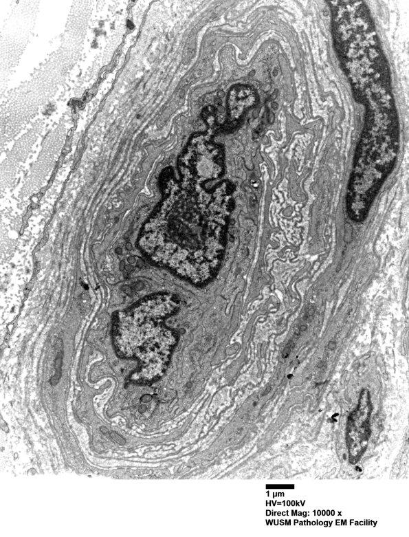 16B7 (Case 16) HIEM EM026 - Copy