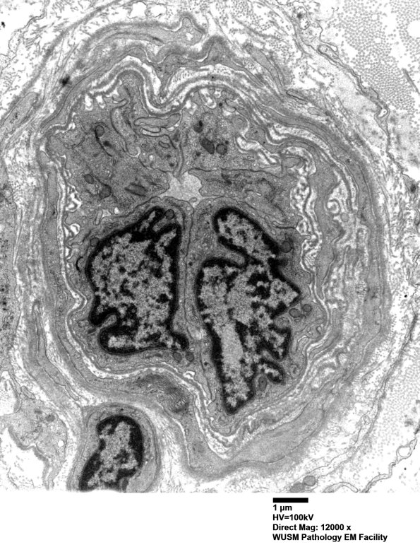 16B9 (Case 16) HIEM EM030 - Copy