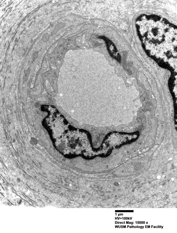 17B2 (Case 17) HIEM EM016 - Copy