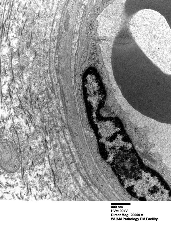 17B5 (Case 17) HIEM EM019 - Copy