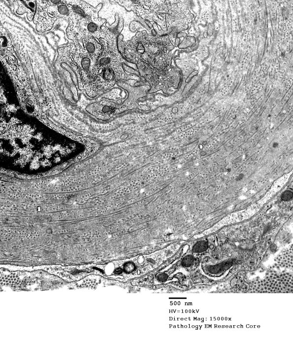 1B3 Vasculopathy (Case 1) EM017 - Copy