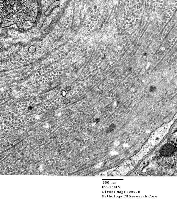 1B4 Vasculopathy (Case 1) EM021 - Copy