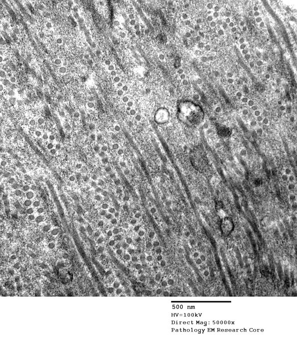1B5 Vasculopathy (Case 1) EM036 - Copy