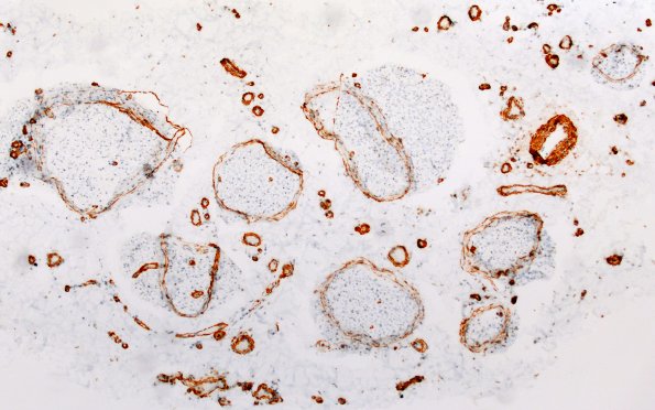 2B Vasculopathy (Case 2) SMA 10X 1