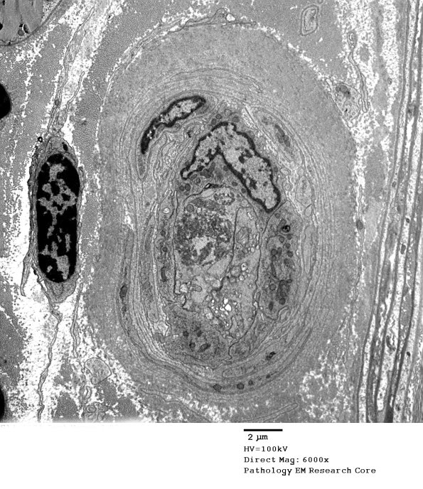 2D8 Vasculopathy (Case 2) EM039 - Copy