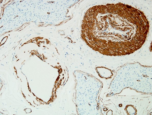 3B Vasculopathy (Case 3) SMA 1