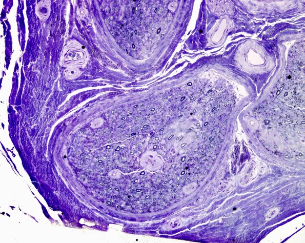 3C2 Vasculopathy (Case 3 Plastic 1
