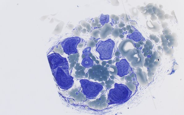 4A1 Vasculopathy (Case 4) Plastic 4X 1